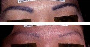 cosmetic tattoo removal 5
