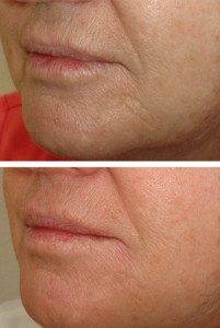 Cosmetic Injections Treatments 1