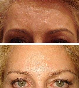 Cosmetic Injections Treatments 8