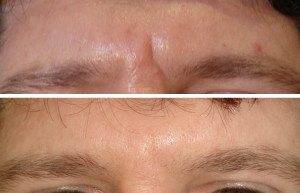 Cosmetic Injections Treatments 9