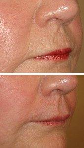 Cosmetic Injections Treatments 11