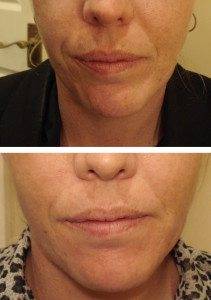 Cosmetic Injections Treatments 12