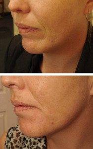 Cosmetic Injections Treatments 13
