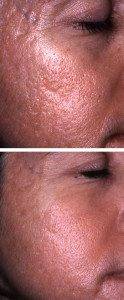 Scar Removal Treatments 1