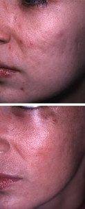 Scar Removal Treatments 2