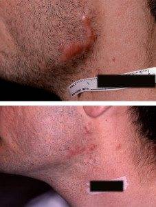 Scar Removal Treatments 4