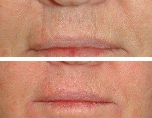 Scar Removal Treatments 7