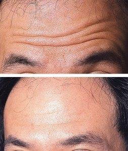 Line and Wrinkle Treatment