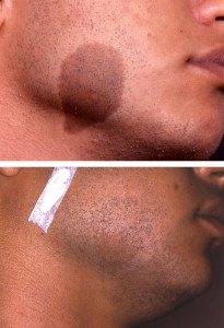 Birthmarks before and after 2