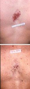 Birthmarks before and after 4