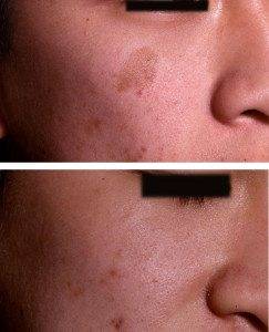 Birthmarks before and after 7
