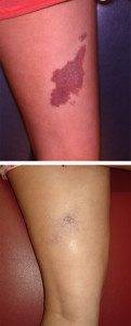 Birthmarks before and after 13