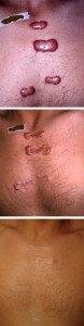 Scar Removal Treatments 3