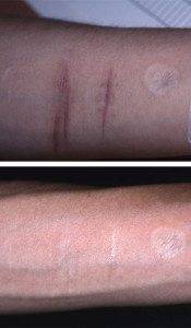 Scar Removal Treatments 6