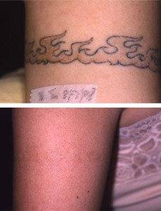 Tattoo Laser Removal 2