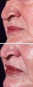 Skin Papules Nose Aura
